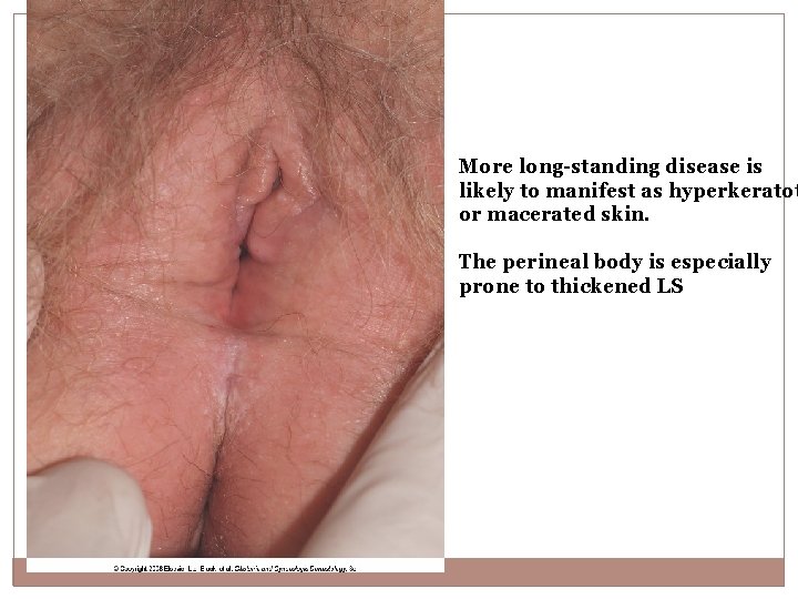 More long-standing disease is likely to manifest as hyperkeratot or macerated skin. The perineal