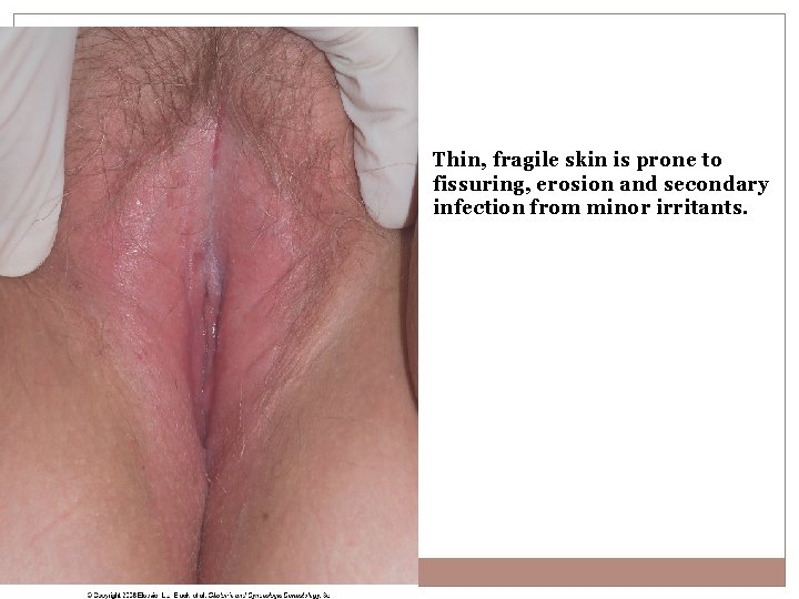 Thin, fragile skin is prone to fissuring, erosion and secondary infection from minor irritants.