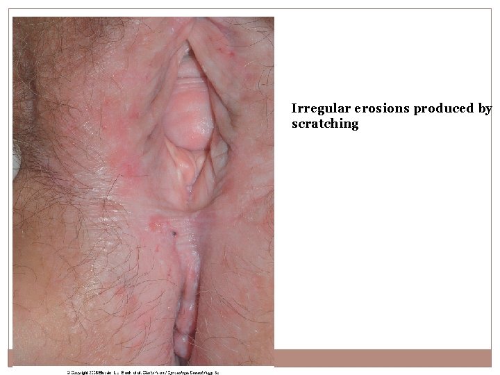 Irregular erosions produced by scratching 