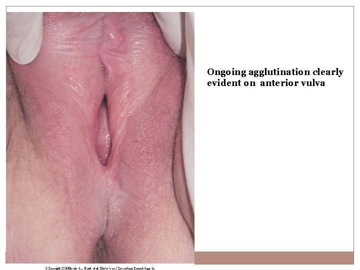 Ongoing agglutination clearly evident on anterior vulva 