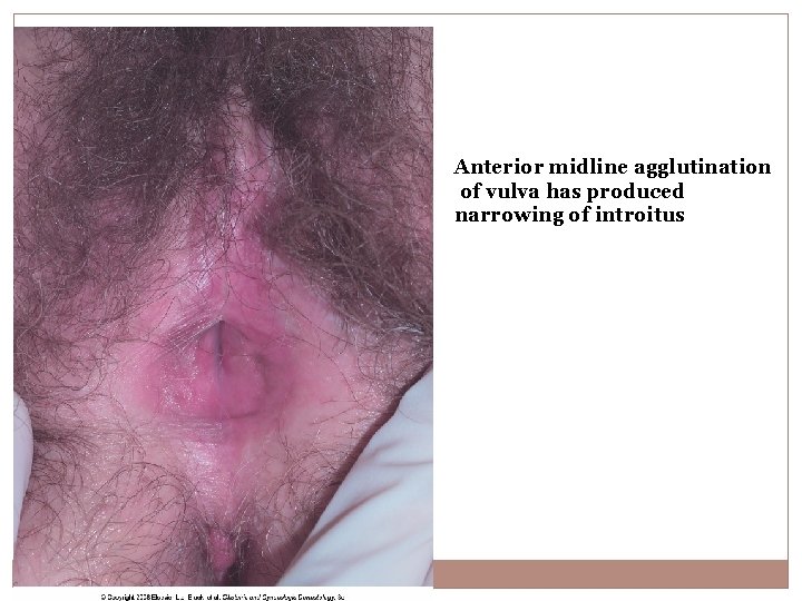 Anterior midline agglutination of vulva has produced narrowing of introitus 