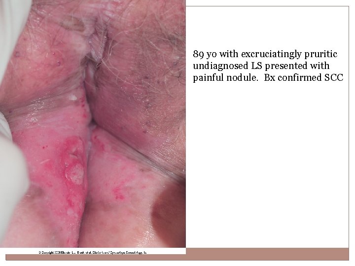 89 yo with excruciatingly pruritic undiagnosed LS presented with painful nodule. Bx confirmed SCC
