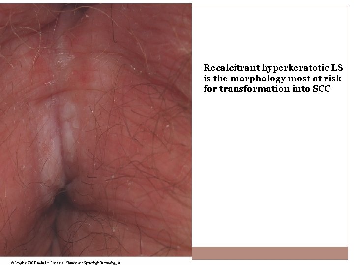 Recalcitrant hyperkeratotic LS is the morphology most at risk for transformation into SCC 