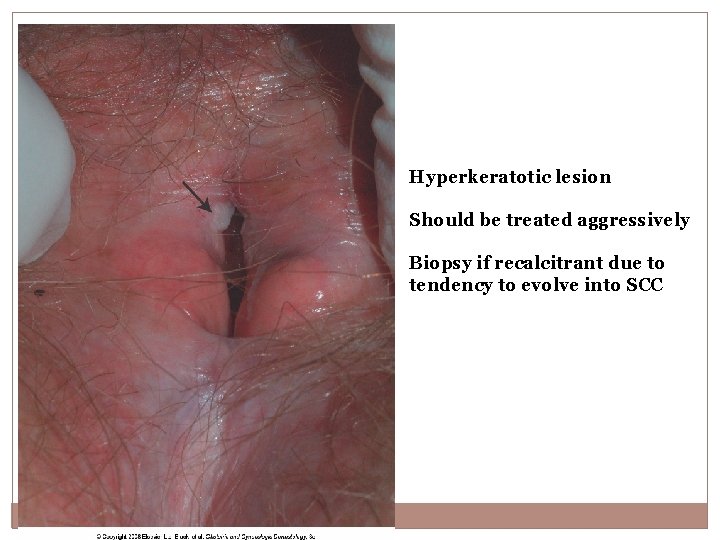 Hyperkeratotic lesion Should be treated aggressively Biopsy if recalcitrant due to tendency to evolve