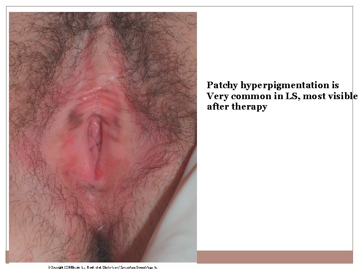 Patchy hyperpigmentation is Very common in LS, most visible after therapy 