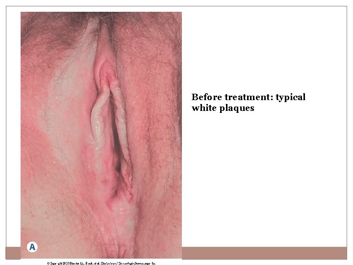 Before treatment: typical white plaques 