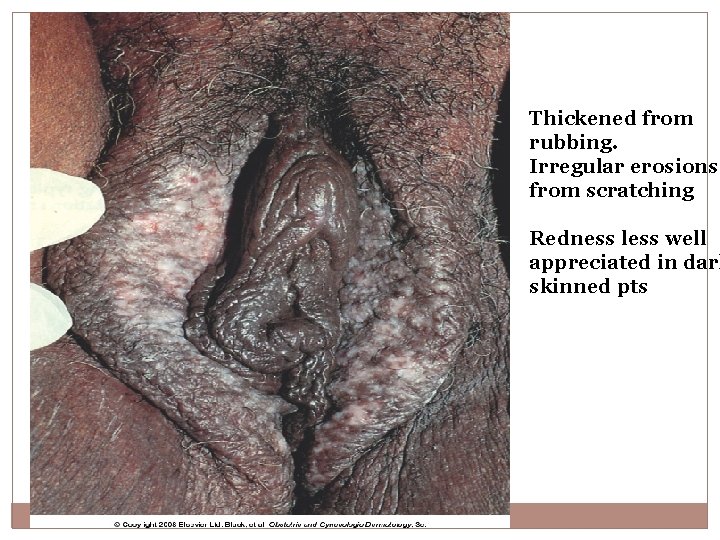 Thickened from rubbing. Irregular erosions from scratching Redness less well appreciated in dark skinned