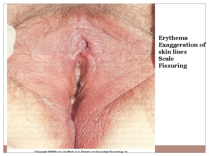 Erythema Exaggeration of skin lines Scale Fissuring 