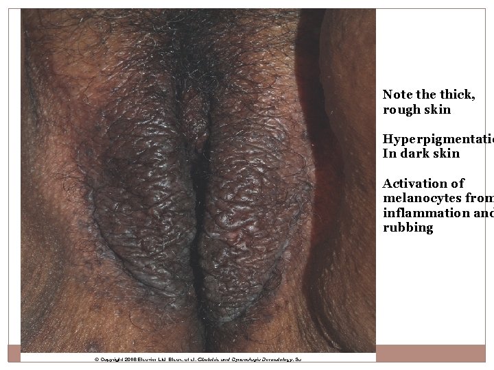 Note thick, rough skin Hyperpigmentatio In dark skin Activation of melanocytes from inflammation and