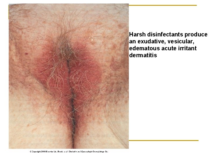 Harsh disinfectants produce an exudative, vesicular, edematous acute irritant dermatitis 