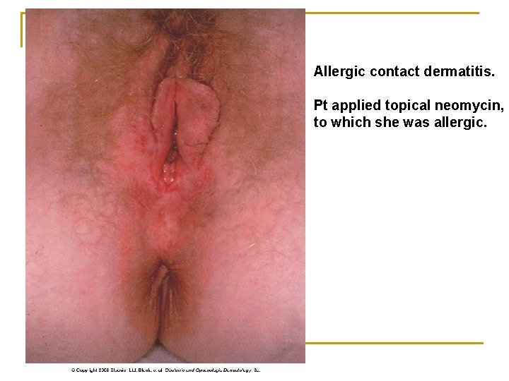 Allergic contact dermatitis. Pt applied topical neomycin, to which she was allergic. 