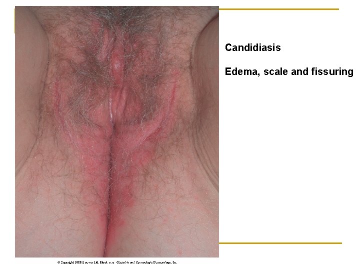 Candidiasis Edema, scale and fissuring 