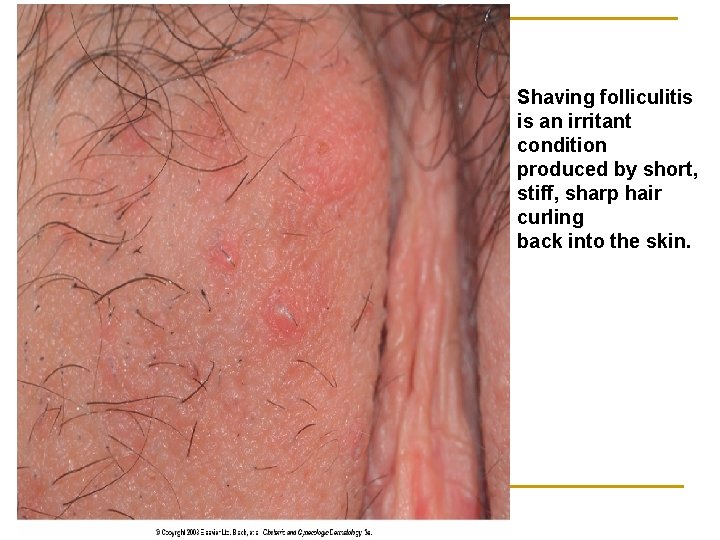 Shaving folliculitis is an irritant condition produced by short, stiff, sharp hair curling back