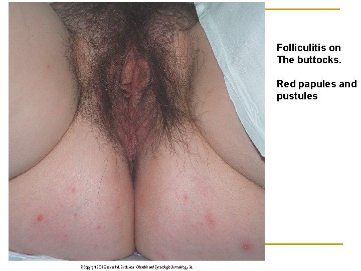 Folliculitis on The buttocks. Red papules and pustules 