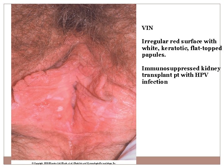 VIN Irregular red surface with white, keratotic, flat-topped papules. Immunosuppressed kidney transplant pt with