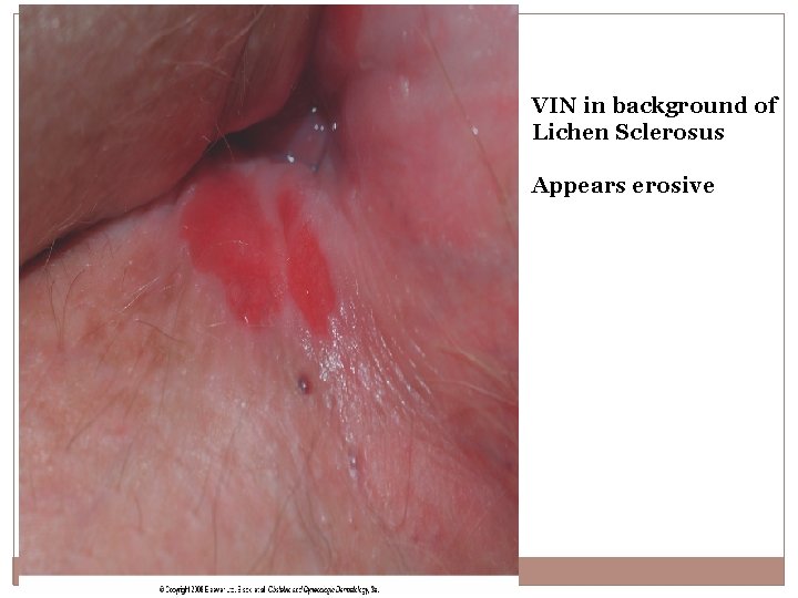 VIN in background of Lichen Sclerosus Appears erosive 