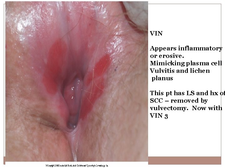 VIN Appears inflammatory or erosive. Mimicking plasma cell Vulvitis and lichen planus This pt