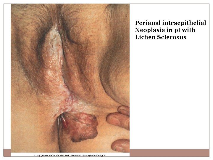 Perianal intraepithelial Neoplasia in pt with Lichen Sclerosus 