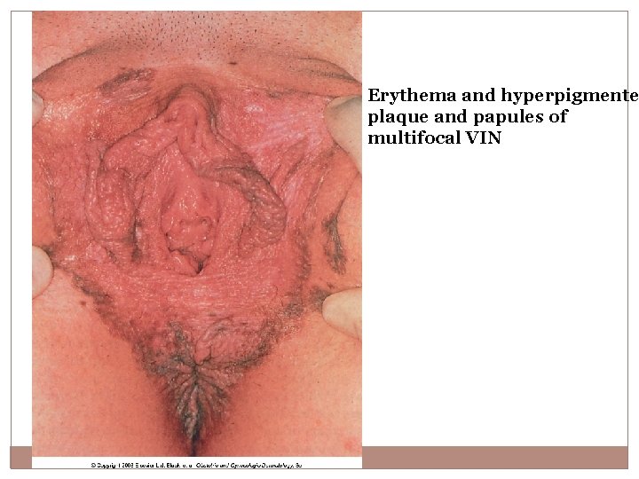 Erythema and hyperpigmente plaque and papules of multifocal VIN 