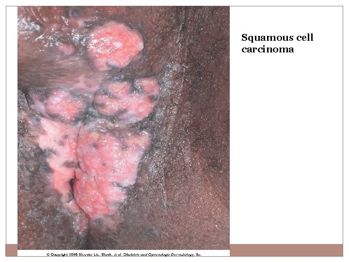 Squamous cell carcinoma 