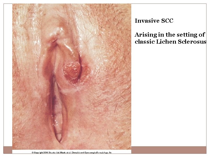 Invasive SCC Arising in the setting of classic Lichen Sclerosus 