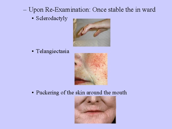 – Upon Re-Examination: Once stable the in ward • Sclerodactyly • Telangiectasia • Puckering – Upon Re-Examination: Once stable the in ward • Sclerodactyly • Telangiectasia • Puckering