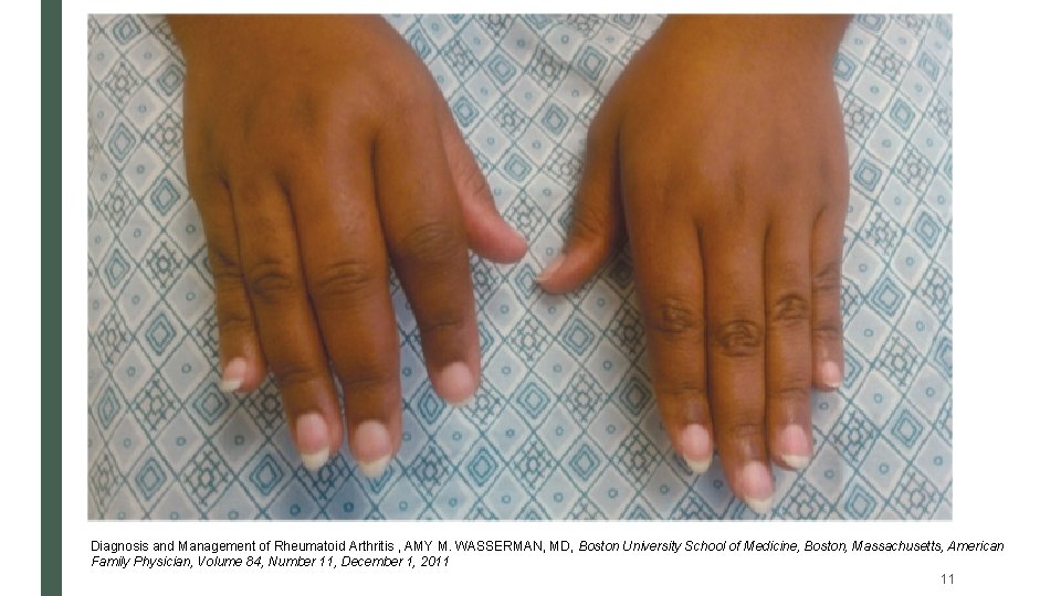 Diagnosis and Management of Rheumatoid Arthritis , AMY M. WASSERMAN, MD, Boston University School