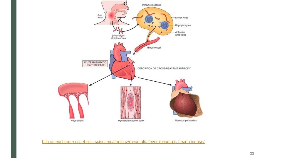 http: //medchrome. com/basic-science/pathology/rheumatic-fever-rheumatic-heart-disease/ 33 