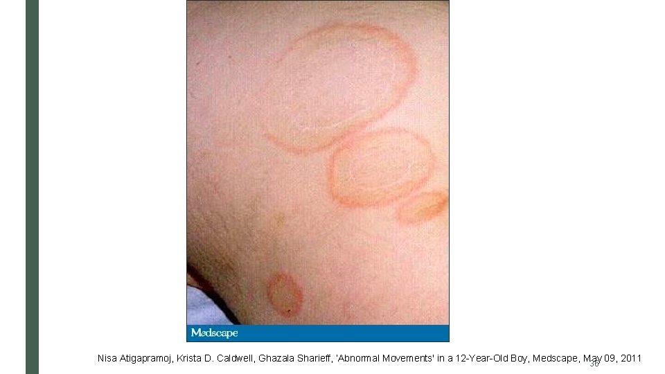 Nisa Atigapramoj, Krista D. Caldwell, Ghazala Sharieff, ‘Abnormal Movements' in a 12 -Year-Old Boy,