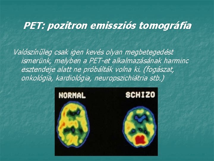 PET: pozitron emissziós tomográfia Valószínűleg csak igen kevés olyan megbetegedést ismerünk, melyben a PET-et