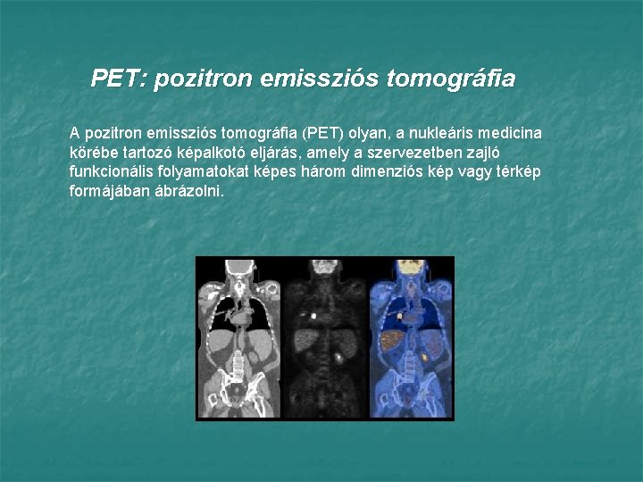 PET: pozitron emissziós tomográfia A pozitron emissziós tomográfia (PET) olyan, a nukleáris medicina körébe