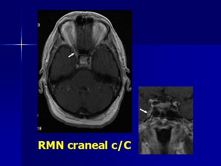 RMN craneal c/C 