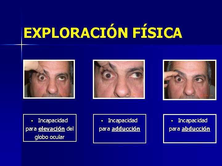 EXPLORACIÓN FÍSICA Incapacidad para elevación del globo ocular § Incapacidad para adducción § Incapacidad