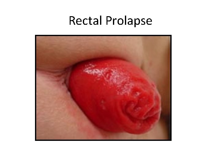 Rectal Prolapse 