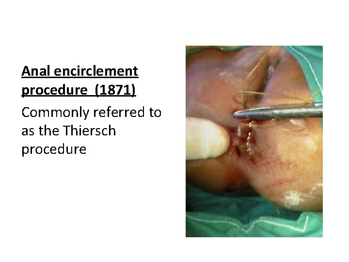 Anal encirclement procedure (1871) Commonly referred to as the Thiersch procedure 