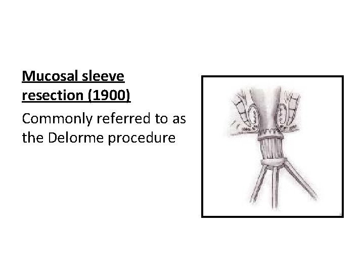 Mucosal sleeve resection (1900) Commonly referred to as the Delorme procedure 