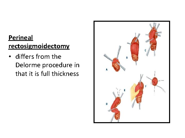 Perineal rectosigmoidectomy • differs from the Delorme procedure in that it is full thickness