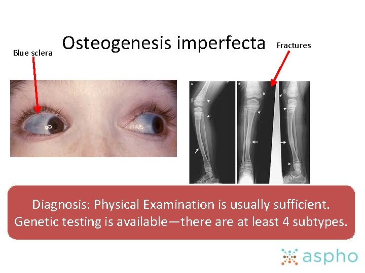 Blue sclera Osteogenesis imperfecta Fractures Diagnosis: Physical Examination is usually sufficient. Genetic testing is