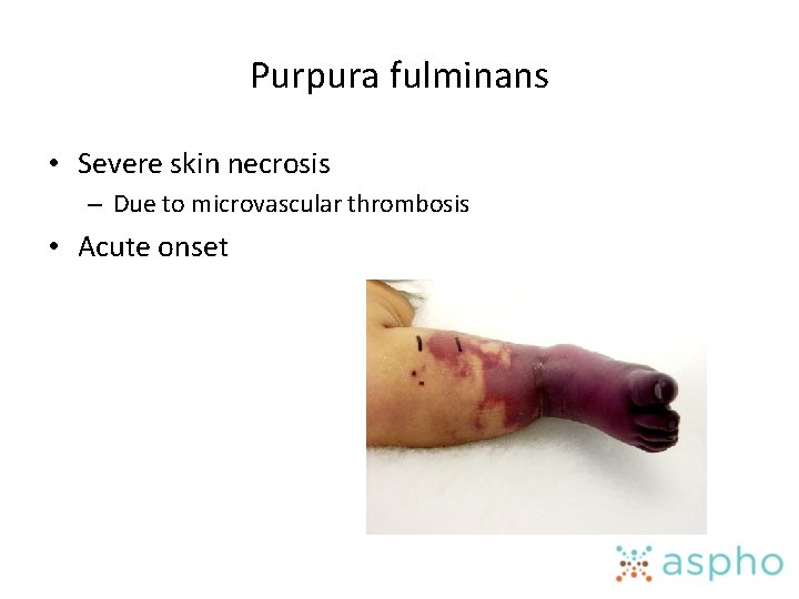 Purpura fulminans • Severe skin necrosis – Due to microvascular thrombosis • Acute onset