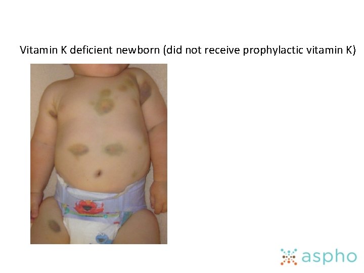 Vitamin K deficient newborn (did not receive prophylactic vitamin K) 