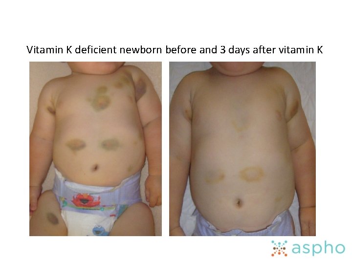 Vitamin K deficient newborn before and 3 days after vitamin K 