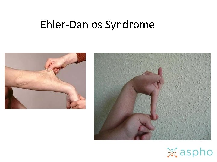 Ehler-Danlos Syndrome 