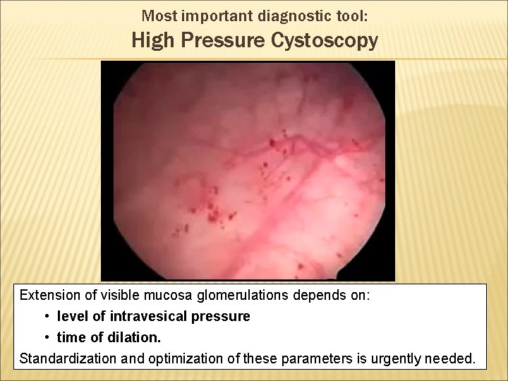 Most important diagnostic tool: High Pressure Cystoscopy Extension of visible mucosa glomerulations depends on:
