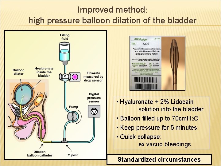 Improved method: high pressure balloon dilation of the bladder • Hyaluronate + 2% Lidocain
