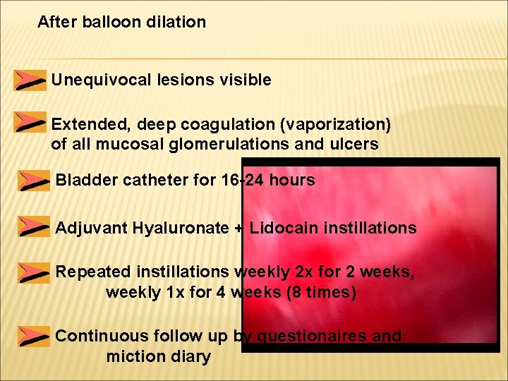 After balloon dilation Unequivocal lesions visible Extended, deep coagulation (vaporization) of all mucosal glomerulations