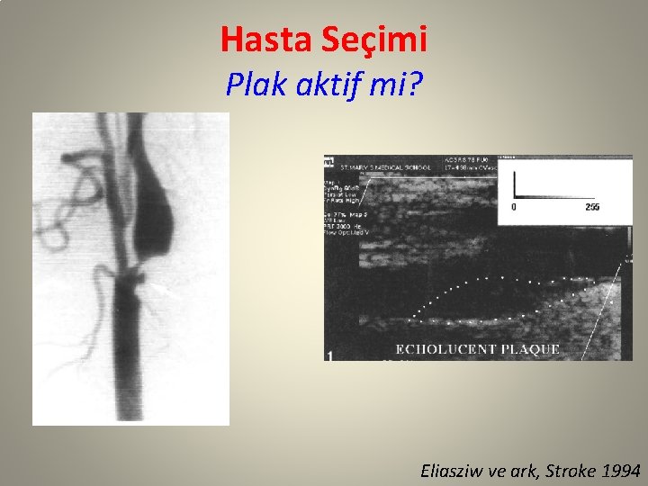 Hasta Seçimi Plak aktif mi? Eliasziw ve ark, Stroke 1994 