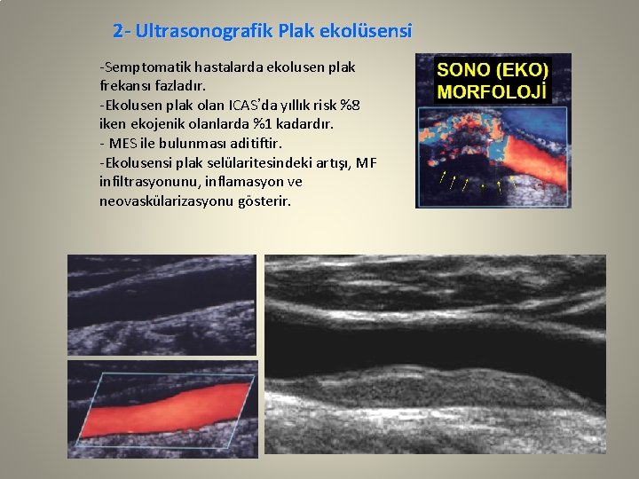 2 - Ultrasonografik Plak ekolüsensi -Semptomatik hastalarda ekolusen plak frekansı fazladır. -Ekolusen plak olan