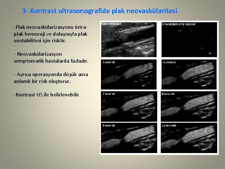 3 - Kontrast ultrasonografide plak neovaskülaritesi -Plak neovaskülarizasyonu intraplak hemoraji ve dolayısıyla plak unstabilitesi