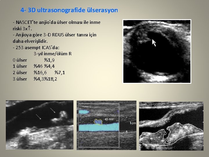 4 - 3 D ultrasonografide ülserasyon - NASCET’te anjio’da ülser olması ile inme riski