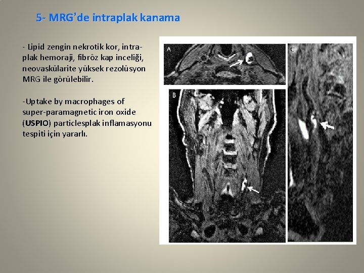 5 - MRG’de intraplak kanama - Lipid zengin nekrotik kor, intraplak hemoraji, fibröz kap